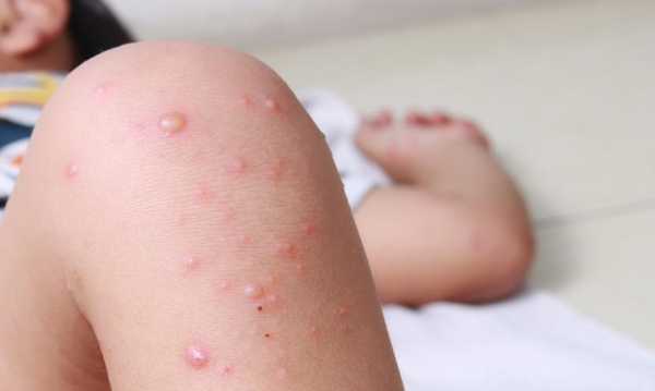 Kanada Zmaga Si Z Powrotem Odry Niewystarczajcy Poziom Wyszczepienia F7d0f9e, Biznes Fakty