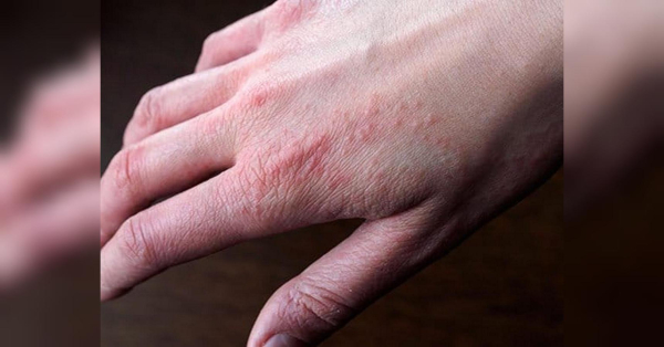 Swędząca wysypka po narażeniu na zimno: może to być znak ostrzegawczy